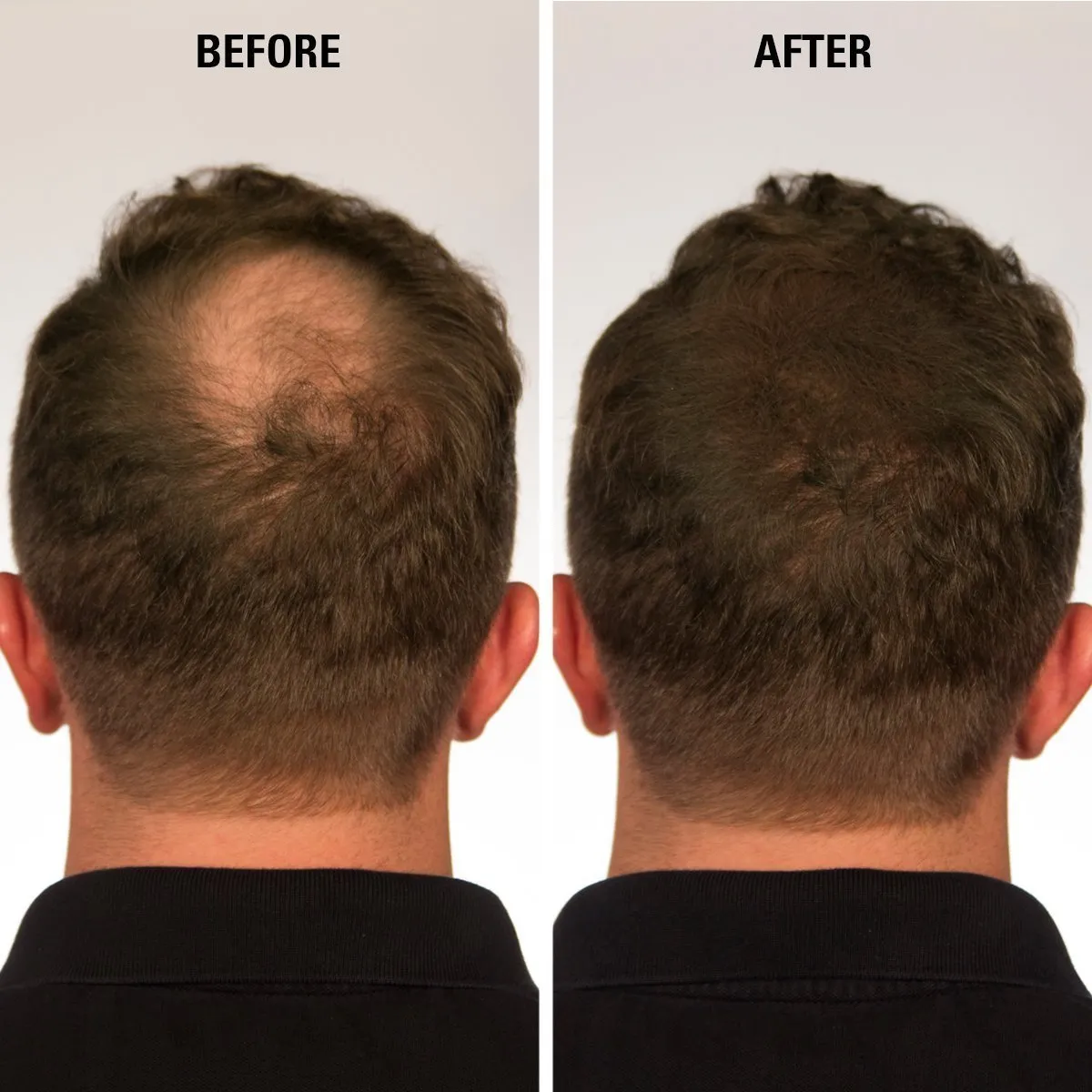 ECLIPSE Hair Fibers Medium Brown for Thinning Hair for Women & Men to Conceal Hair Loss in 15 Seconds - 100% Undetectable Hair Building Fibers, 30g