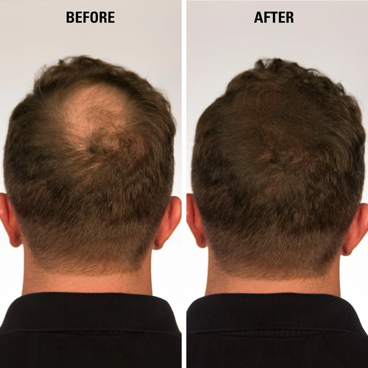 ECLIPSE Hair Fibers Medium Brown for Thinning Hair for Women & Men to Conceal Hair Loss in 15 Seconds - 100% Undetectable Hair Building Fibers, 60g